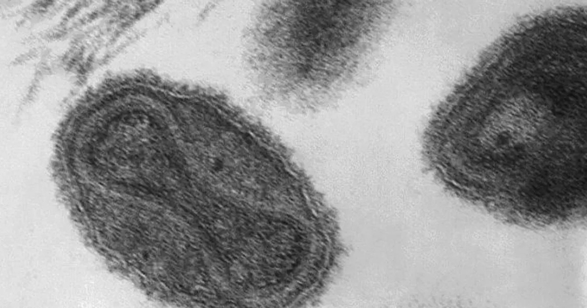 UK Confirms Local Spread Of monkeypox